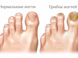 Лечение грибка — процесс долгий. Сейчас я дам несколько рецептов. Попробуйте разные